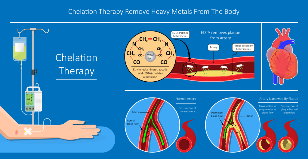 Chelation Therapy, العلاج في الهند بنغالور أفضل مستشفيات في الهند العلاج الطبي في الهند Affordable medical treatment India Best hospitals in Bangalore Medical tourism in India Specialist doctors in Bangalore Heart surgery in India Cancer treatment Bangalore Best healthcare in India Al Hadi Medical Tourism Best Doctor in Bangalore